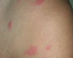 Urticaria / hives - pruritic wheals form after mast cell degranulation