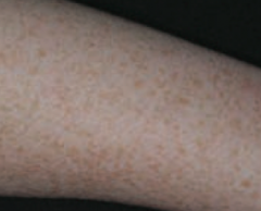 Ephelis - freckles
- Normal number of melanocytes, with ↑ melanin pigment