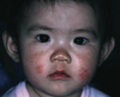 Atopic Dermatitis (Eczema)
- Pruritic eruption, commonly on skin flexures