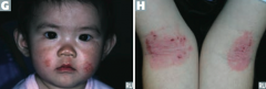 - Usually starts on face in infancy (G)
- Often appears in antecubital fossae thereafter (H)