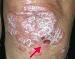 What common skin finding is this? What sign is this arrow pointing at?
