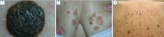 What is the name of the sign for the sudden appearance of multiple seborrheic keratoses? What does this indicate?