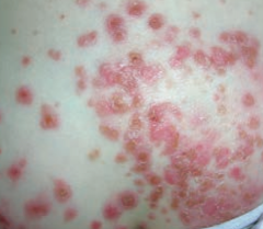 What skin disorder is characterized by "honey-colored crusting"? Most common causes?
