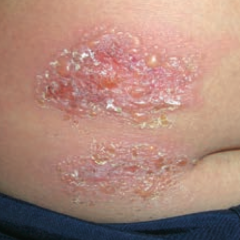 What skin disorder is this? Most common causes?