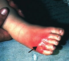 Cellulitis
- Acute, painful, spreading infection of dermis and subcutaneous tissues
- Usually from S. pyogenes or S. aureus