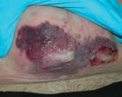 What skin disorder causes bullae and a purple color to the skin? Most common causes?