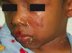 Staphylococcal Scalded Skin Syndrome
- Exotoxin destroys the keratinocyte attachments in the stratum GRANULOSUM only