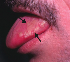 What skin disorder causes white, painless plaques on the tongue that cannot be scraped off? Most common cause?