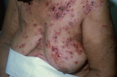 Which skin disorder causes flaccid intraepidermal bullae and affects the oral mucosa? Cause?