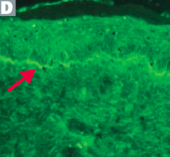 - Immunofluorescence reveals linear pattern at epidermal-dermal junction
- Tense blisters contain eosinophils
- Nikolsky sign (-) = separation of epidermis upon manual stroking of skin