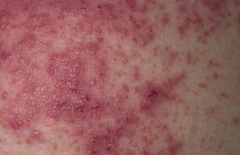 Which skin disorder causes pruritic papules, vesicles, and bullae (often on the elbows)? Cause / associations?
