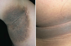 Acanthosis Nigricans
- Epidermal hyperplasia
- Associated with hyperinsulinemia (eg, diabetes, obesity, Cushing syndrome) and visceral malignancies (eg, gastric adenocarcinoma)