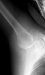 This patient has suffered an inferior shoulder dislocation (luxatio erecta). This is a rare type of shoulder dislocation, representing only about 0.5% of all shoulder dislocations. Anterior and posterior dislocations are much more common but don't...
