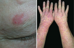 What premalignant lesion is caused by sun exposure, leading to a small, rough, erythamtous or brownish papule or plaque? What can it progress to?