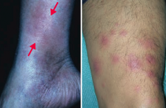 Painful, inflammatory lesions of subcutaneous fat, usually on anterior shins