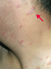 Herald Patch - sign of Pityriasis Rosea