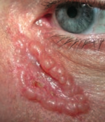 Basal Cell Carcinoma
- Pink, pearly nodules
- Commonly with telangiectasias, rolled borders, and central crusting or ulceration