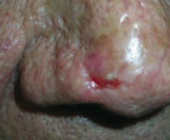 What kind of skin lesion is this? Characteristic appearance?