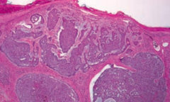 - Palisading nuclei
- Nests of basaloid cells in dermis