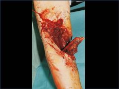 A 26-year-old right hand dominant male is involved in a motor vehicle collision and sustains the left humerus injury demonstrated in Figure A. The brachial artery is disrupted and requires urgent attention in the operating room. The patient's preo...