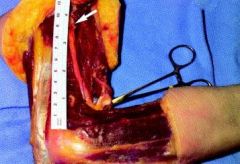 The radial nerve enters the anterior compartment through the intercompartmental fascia on average 10 cm proximal to the radiocapitellar joint. It has never been found to remain in the posterior compartment within 7.5cm of this joint, leading to th...