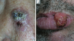 Which type of skin cancer causes ulcerative red lesions with frequent scales, and is associated with chronic draining sinuses?