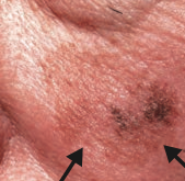 What skin lesion is this?