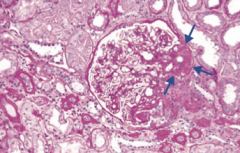 Focal Segmental Glomerulosclerosis