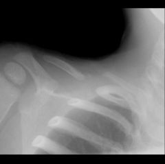 Congenital pseudarthrosis of the clavicle may be confused with a fracture but almost always involves the right middle 1/3 of the clavicle. Its cause is thought to be related to subclavian artery pulsations. It does not have associated fracture cal...