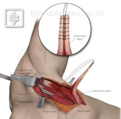 this procedure is predicated on restoring an active ER (subscap) & flex moment at the glenohumeral joint, as these motions constitute the primary functional deficits for this configuration of massive cuff tear (SS &SubScap) younger adult pt w/an i...