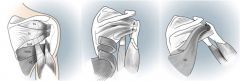this procedure is predicated on restoring an active ER (subscap) & flex moment at the glenohumeral joint, as these motions constitute the primary functional deficits for this configuration of massive cuff tear (SS &SubScap) younger adult pt w/an i...