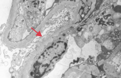 Nephrotic Syndrome:
- Normal glomeruli (lipid may be seen in PCT cells)
- Effacement of foot processes