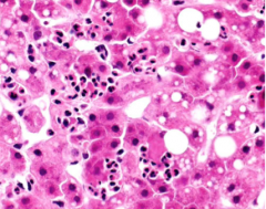 What condition is shown on the slide here? Identify neutrophils and Mallory Denk bodies. 