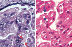 Type I Membrano-Proliferative Glomerulonephritis
- Subendothelial immune complex (IC) deposits
- Granular IF
- "Tram-track" appearance due to GBM splitting caused by mesangial ingrowth