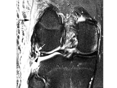 24yo M is involved in a motorcycle accidt & sustains a R knee inj. PE manuever performed @ 30 deg of knee flex  Fig. Which correctly describes the nl anatomic orientation of the region inj in this pt? 1-Popliteus inserts prox to the LCL on the fem...