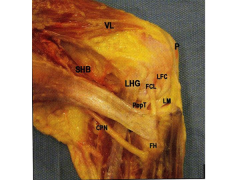 Which best describes the anatomic relationships of the LCL in the posterolateral corner?  1-inserts directly ant to popliteofibular lig on fibula & courses deep to popliteus; 2-inserts anterolaterally-> popliteofibular lig on the fibula & courses ...