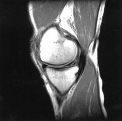 1-(HTO); 2-ACL recon 3- scopic medial partial menisectomy or repair; 4-Posterolateral corner recon;
5-PCL recon:::PCL reconstruction is not indicated in this patient as the physical examination demonstrated a normal quadriceps active test and nor...
