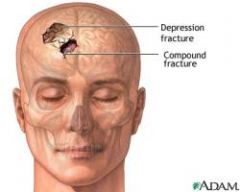 Depressed head fracture