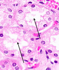 Proximal Tubule cells:
- High cuboidal
- Occluded lumen (d/t long microvilli / brush border)
- Indistinct cell borders (b/c lateral walls highly inter-digitated)
- Few nuclei, basally located in a plane (b/c large cells)
- Eosinophilic, granu...