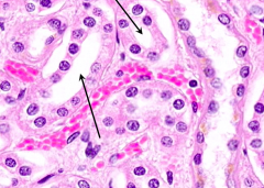 Distal Tubules:
- Low cuboidal epithelium
- Open, wide, smooth contouring lumen (no brush border)
- Indistinct cell borders (d/t extensive inter-digitations)
- Many, centrally located nuclei (smaller cells, so more likely to have nuclei in sec...