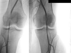 Popliteal Artery Entrapment Syndrome define, how many types? pt c/o? DX