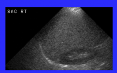 What is shown on ultrasound?