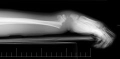 a common type of wrist fracture