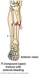 fracture in which the skin has been broken through to the fracture


also called a open fracture