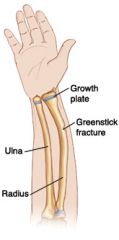 fracture in which there is an incomplete break; one side of  the bone is broken and the other bent. this type of fracture is commonly foun in children due to their softer and more pliable bone structure