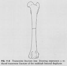 complete fracture that is straight across the bone at right angles to the long axis of the bone