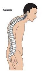 abnormal increase in the outward curvature of th thoracic spine. also known as a hunchback or humpback.