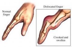 occurs when the bones in a joint are displaced from their normal alignment and the ends of the bones are no longer in contact