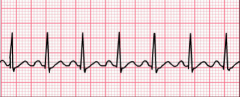  


Determine the type of heart rate