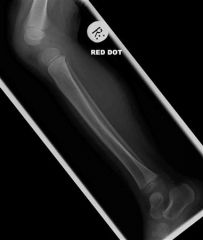 Long leg cast application
The clinical presentation and radiographs are consistent with a toddlers fracture of the tibia and the next step in management includes long leg cast application.
